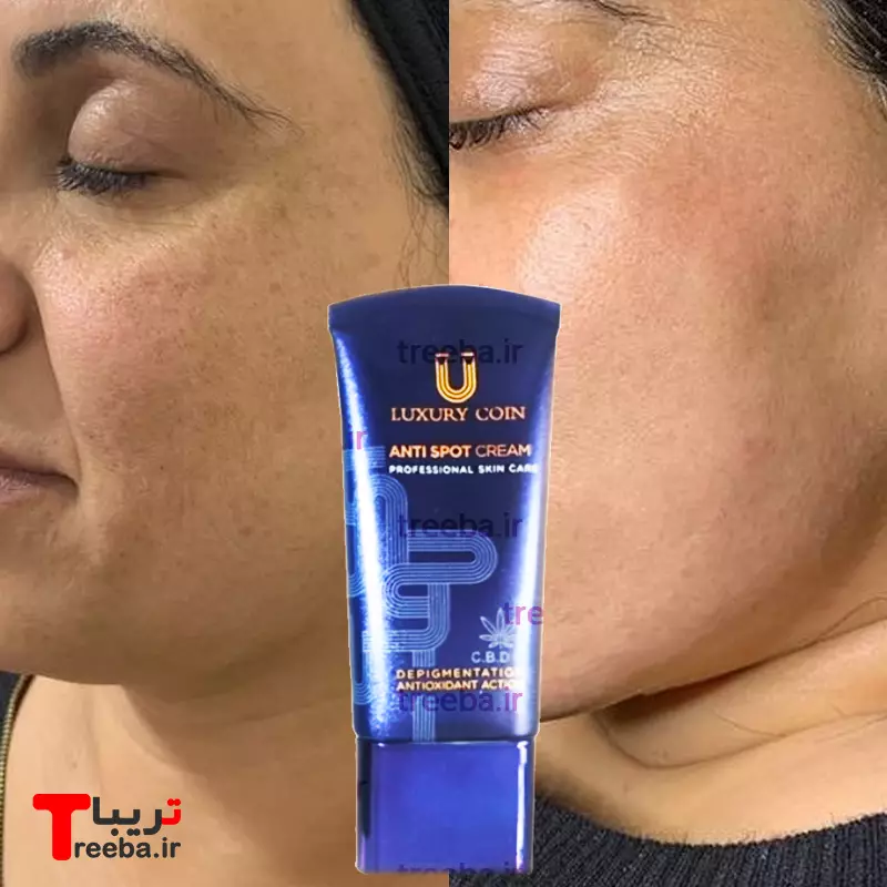 کرم بیوممتیک ضدلک صورت لاکچری کوین مناسب لک های قهوه ایی فرانسوی(قسطی تعداد۲عدذ)