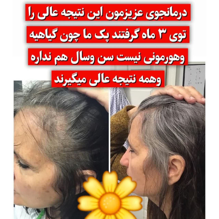 خرید قسطی تونیک ضد ریزش و و رویش مجدد مو دوقلو برند اکسونیک-سوئیس(قسطی تعداد۲عدد)