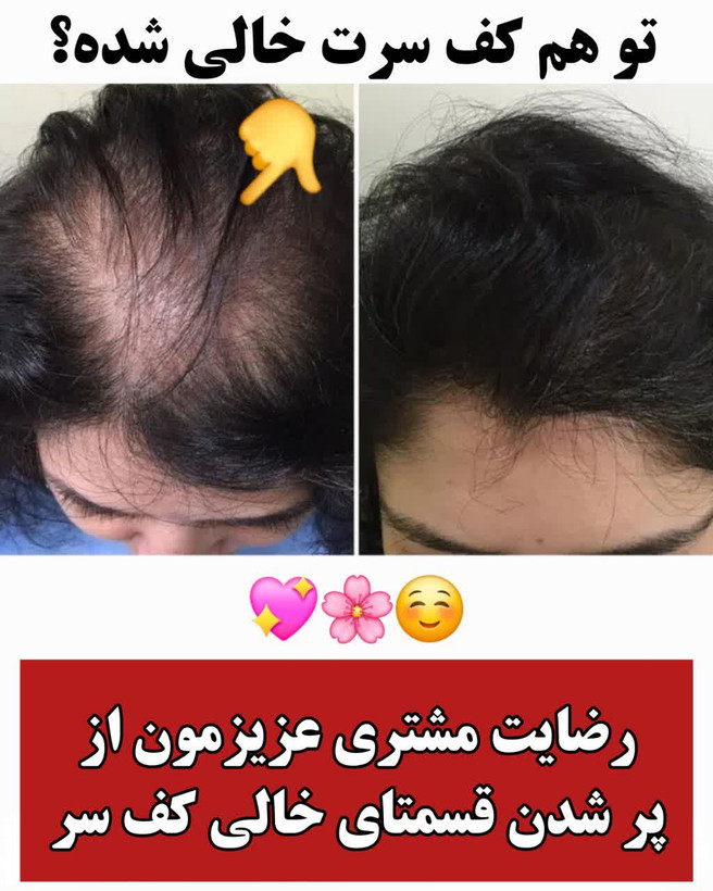 خرید قسطی تونیک ضد ریزش و و رویش مجدد مو دوقلو برند اکسونیک-سوئیس(قسطی تعداد۲عدد)